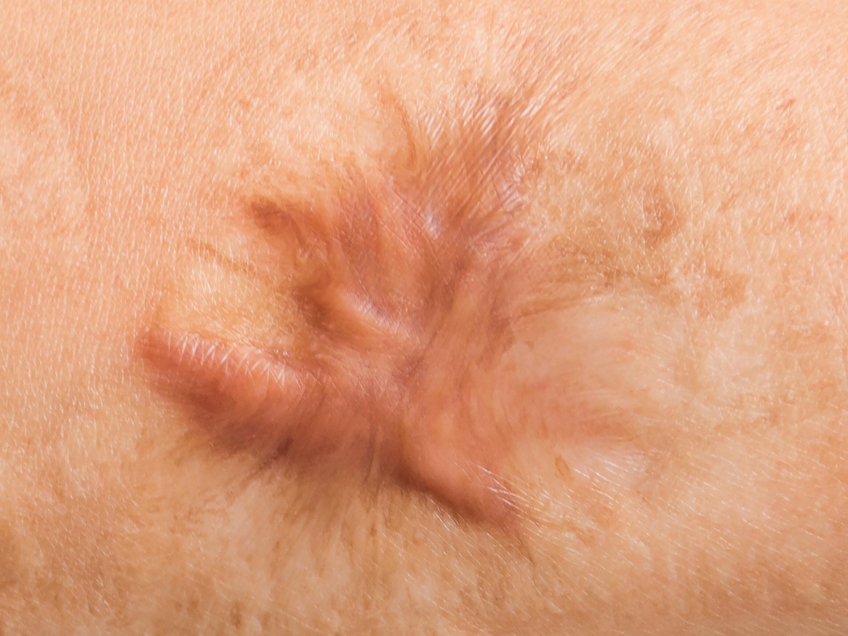 trattamento per cicatrici che causano prurito